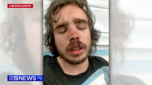 A﻿ Melbourne tradie has been left with serious injuries to his face after being attacked by an e-scooter rider in a road rage incident.Tyler Macaloney was driving home from his panel beating job in Parkville on﻿ Friday when he was confronted by a man who was weaving in and out of traffic.