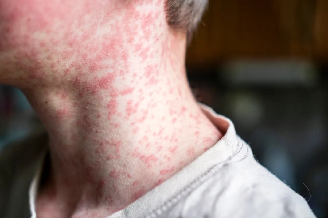 Unvaccinated Bryan County resident is second case of measles in Georgia