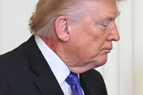 Fierce red rash spotted on Trump's neck