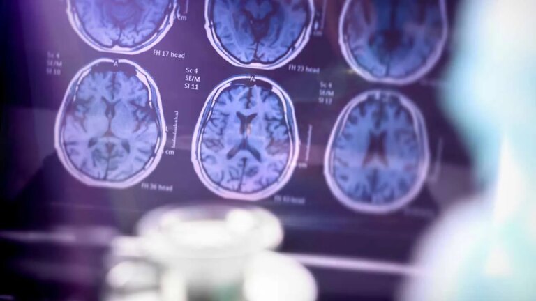 MCG Launches Groundbreaking Deep Brain Stimulation Trials for Alzheimer’s Treatment