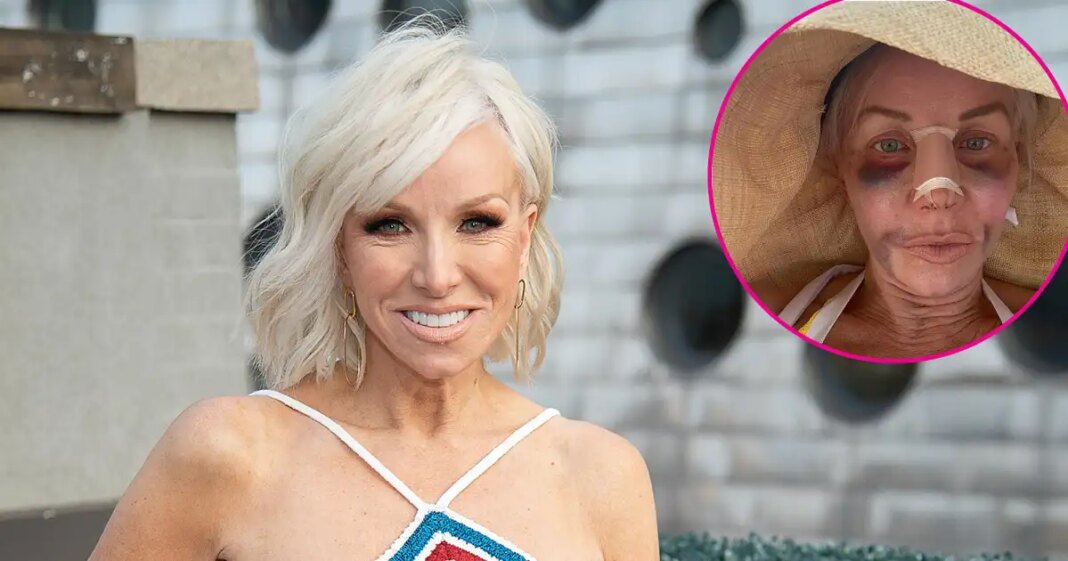 RHONJ's Margaret Josephs Shows Off Nose Job Results After Brutal Recovery