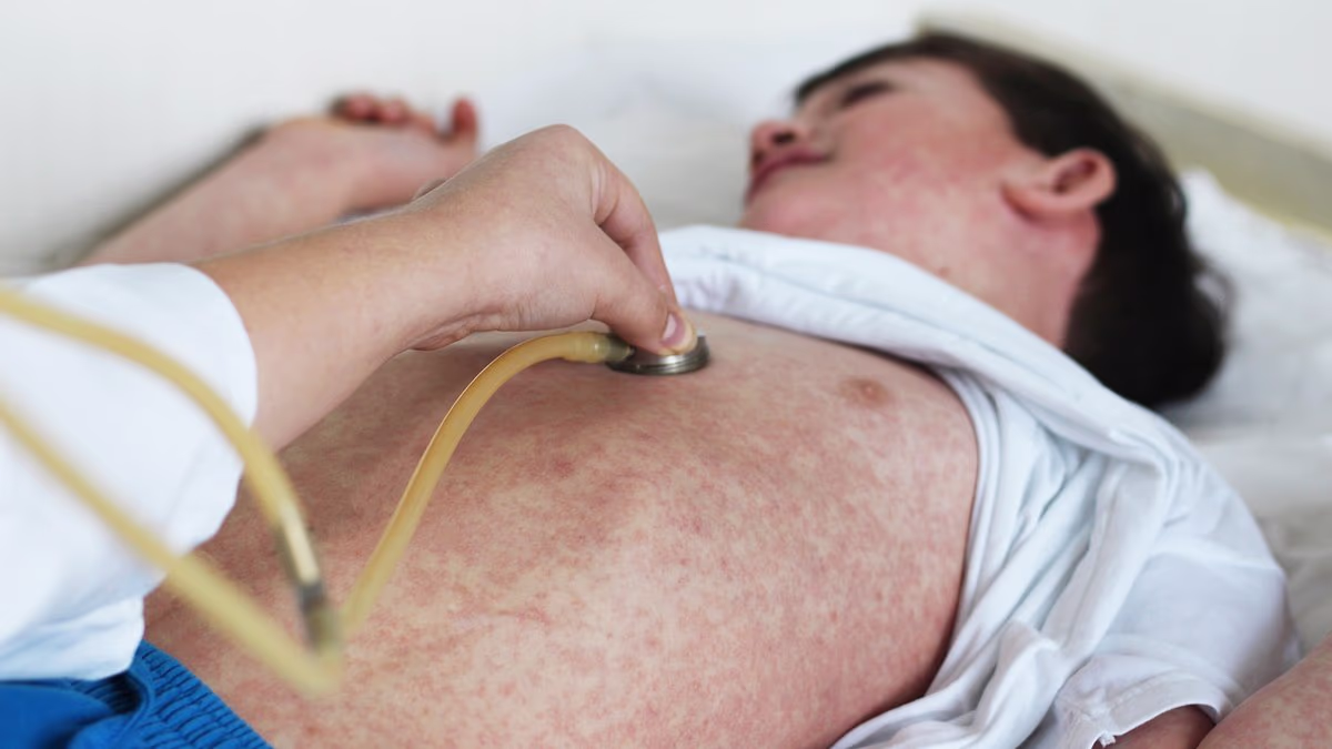 Thousands at risk of deadly complications after measles exposure