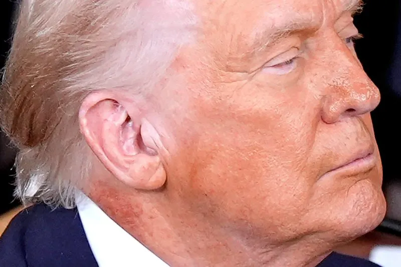 White House attributes redness on Trump’s neck to skin cream but doesn’t say what it’s treating