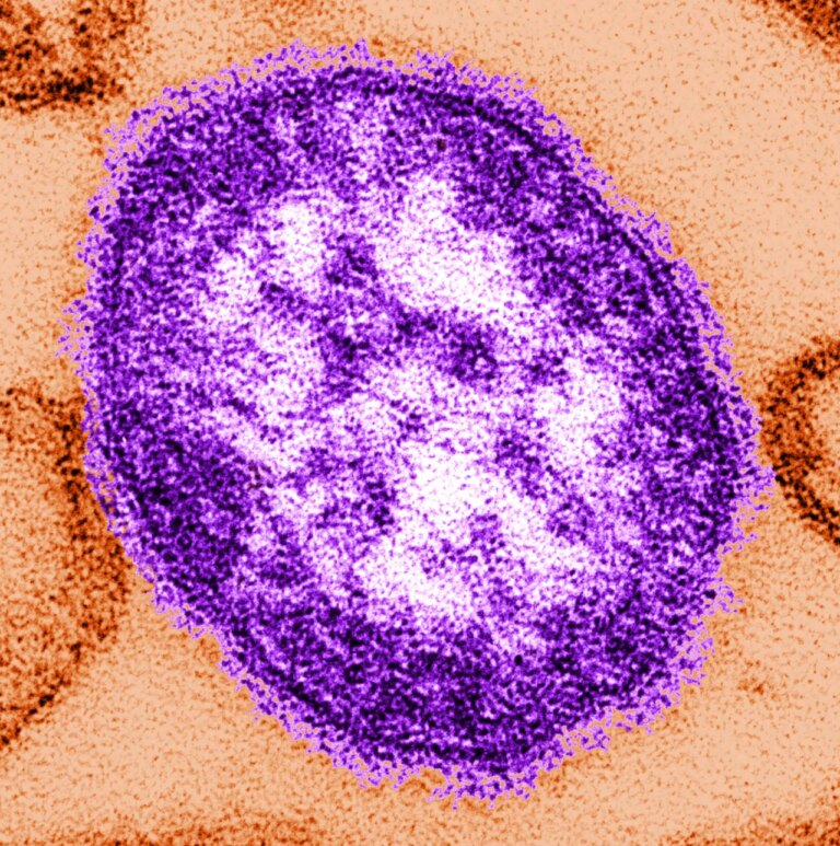 Measles Alert: 34 Individuals May Have Been Exposed in Saluda County