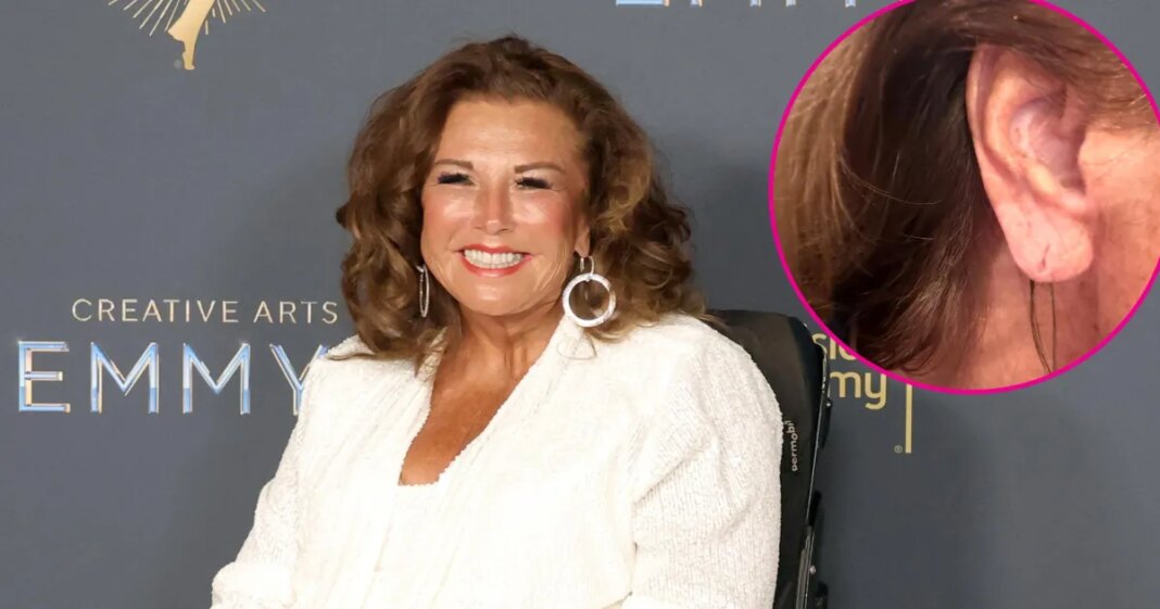 Abby Lee Miller Shows Off Results of $1K Ear Rejuvenation Procedure