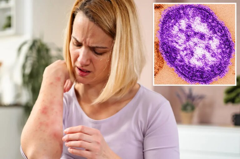 Urgent Health Alert: Measles Detected in California Wastewater Sparks Major Concerns