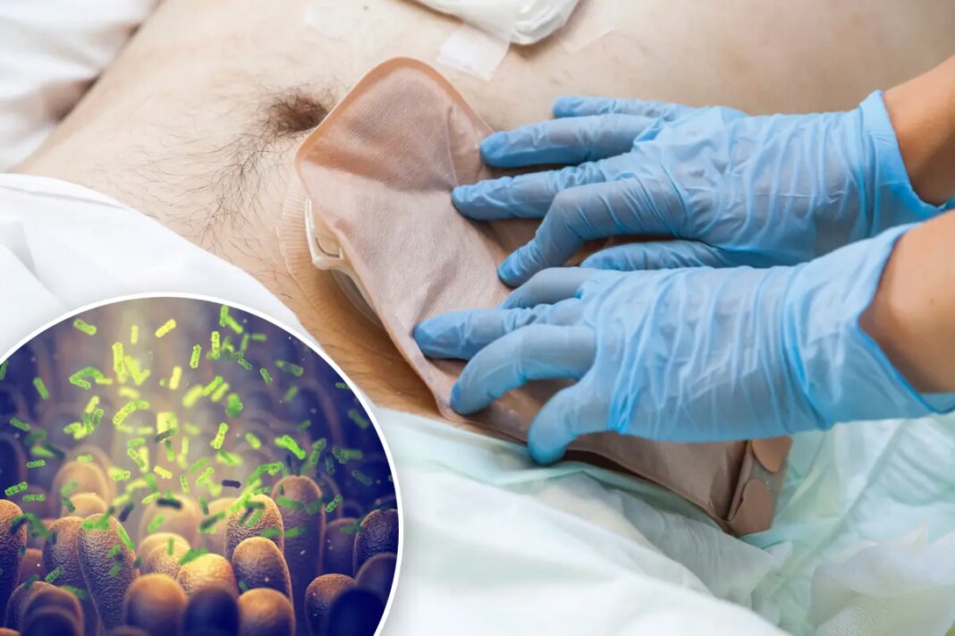 New colorectal cancer discovery could lead to earlier diagnosis