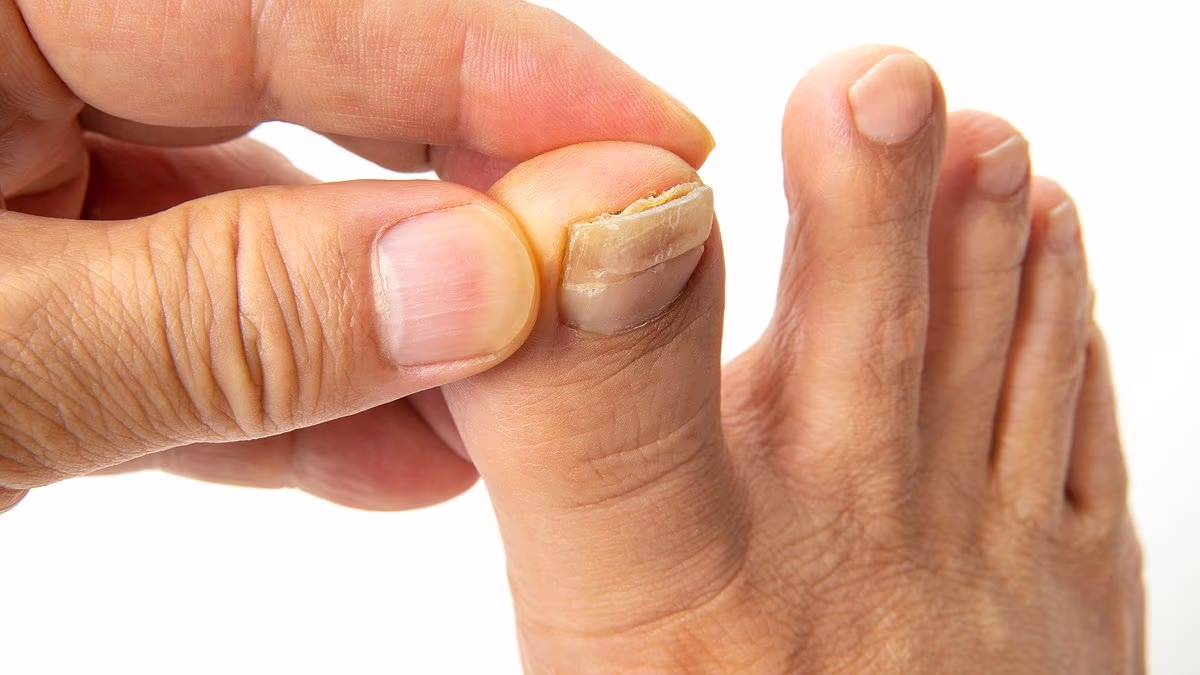 So many of us are struggling with embarrassing crusty, yellow toenails. This is the surprising habit that often triggers the problem - and exactly how to fix it: DR PHILIPPA KAYE