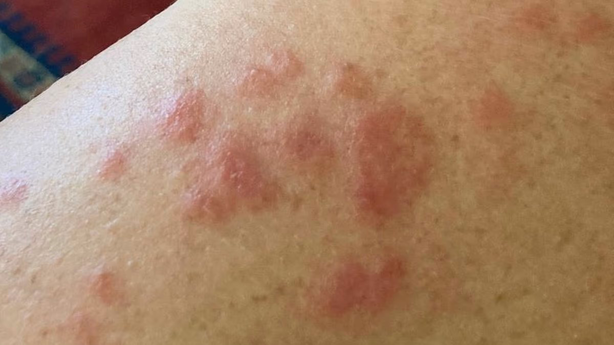 Experts said my hives were rosacea. These are the signs to watch for