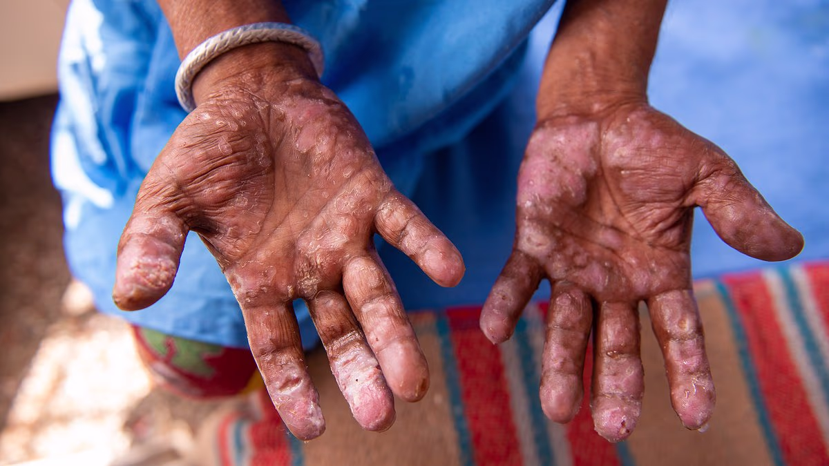 Experts sound alarm over resurgence of ancient disease