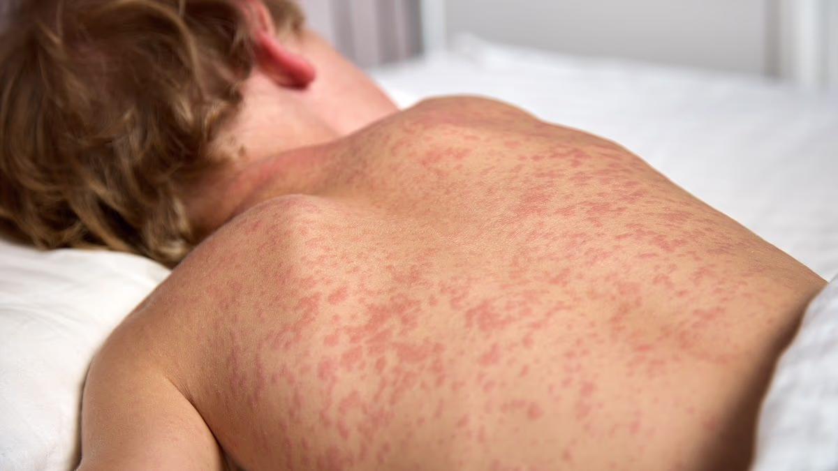 Measles outbreak in multiple states potentially exposes thousands
