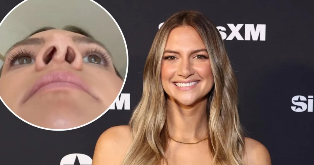 Allison Kuch Shows Close-Up of Her ‘Botched’ Nose After 4 Rhinoplasties