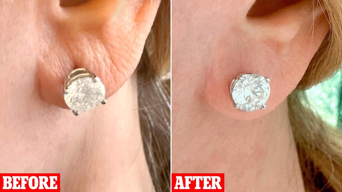 At 69 I've finally fixed my ageing, saggy earlobes with this procedure