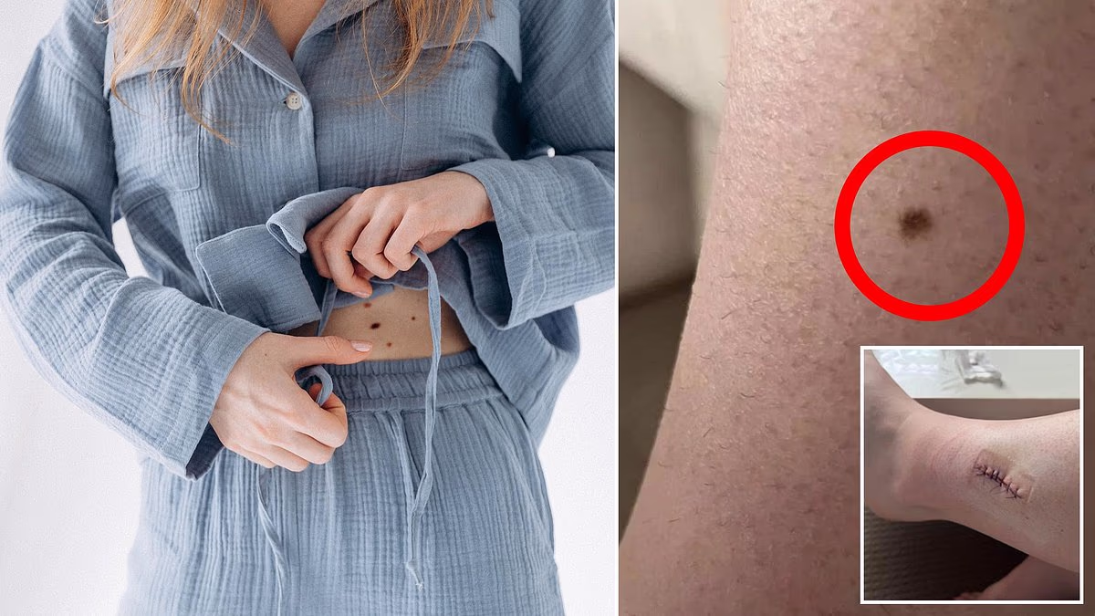 Aussie's warning after 'innocent' mole turned out to be melanoma at 27
