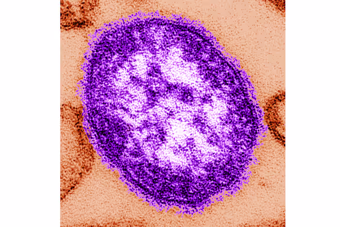 Coroner releases details of infants who died amid growing Pennsylvania measles outbreak