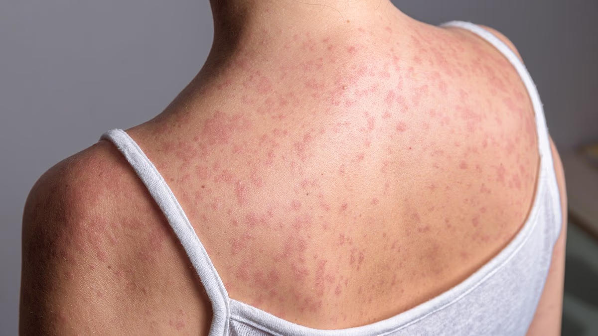 Teen dies of measles-related brain complication amid outbreak